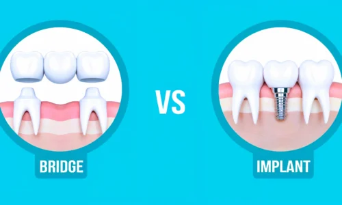 Dental Implant, Dental Bridge