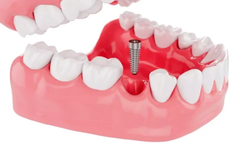 Benefits of Dental Implants