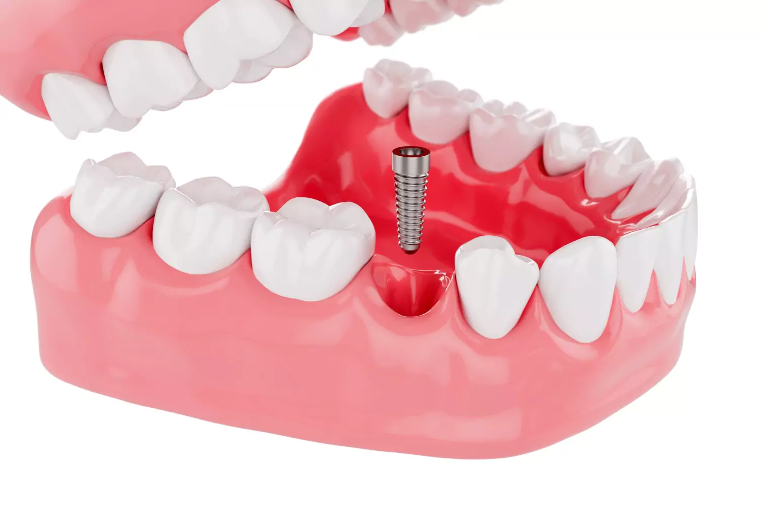 Benefits of Dental Implants