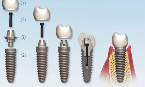 Dental Implant Parts