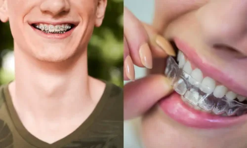 Aligners vs Braces