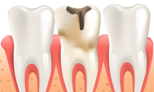 How to Stop Tooth Decay From Spreading