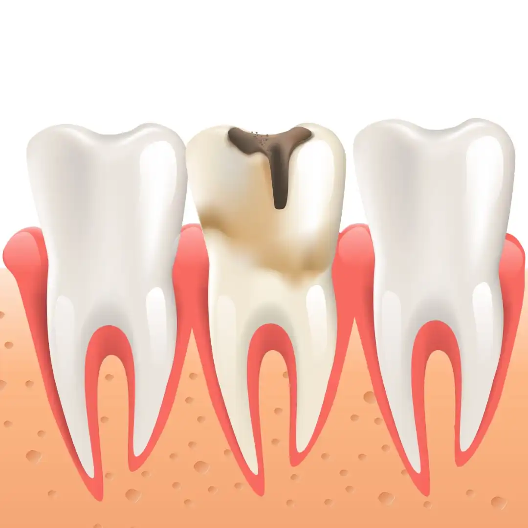 How to Stop Tooth Decay From Spreading