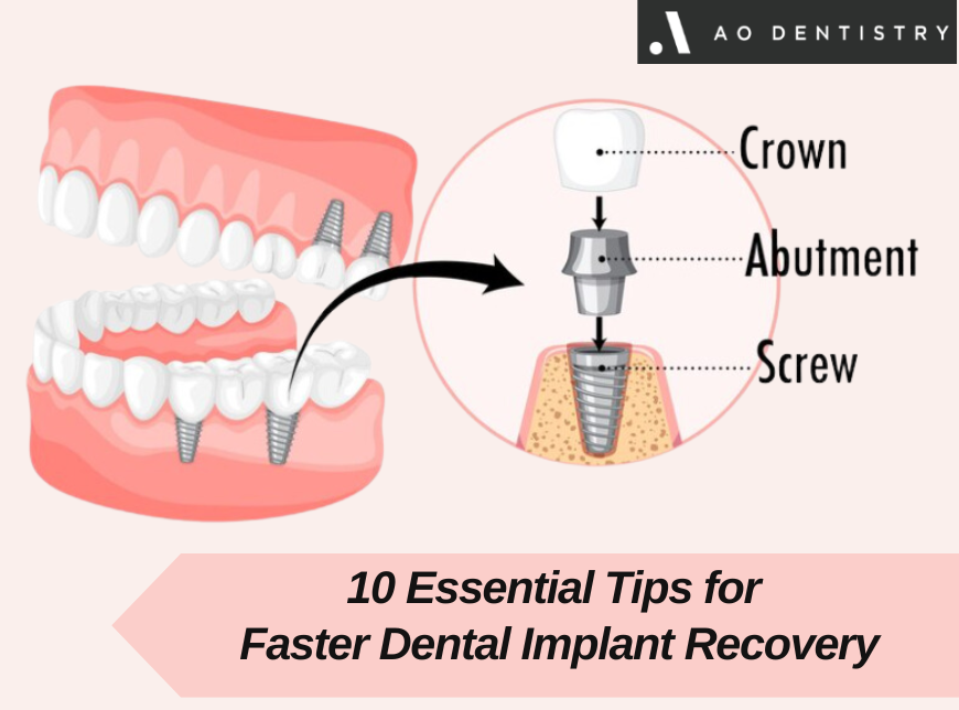 Dental Implants Recovery