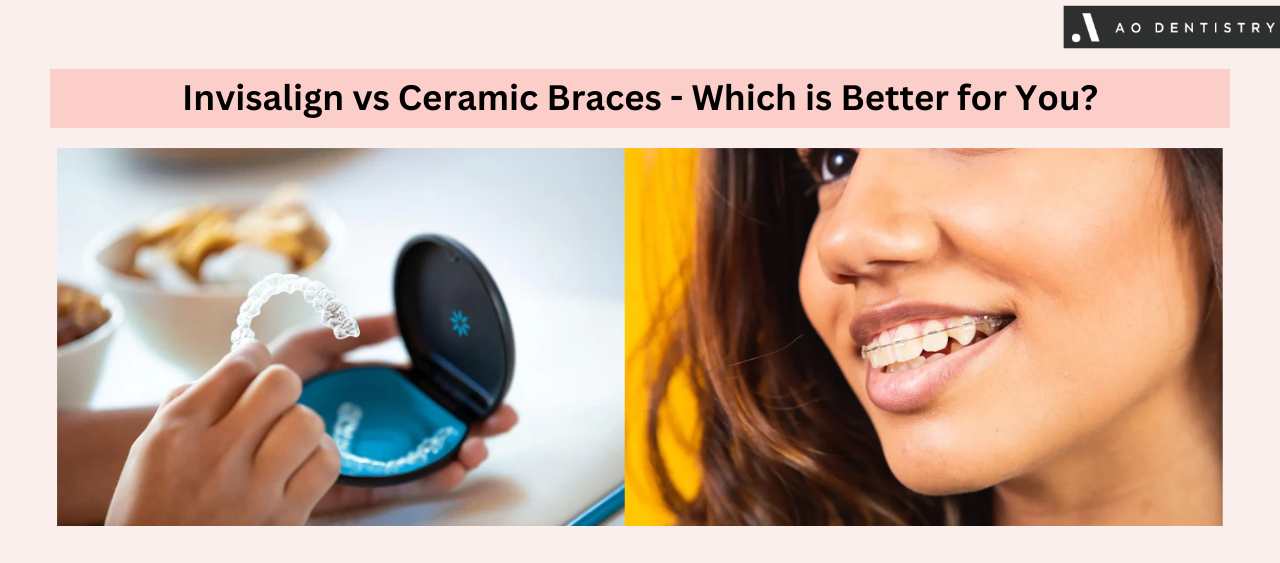 Invisalign vs Ceramic Braces