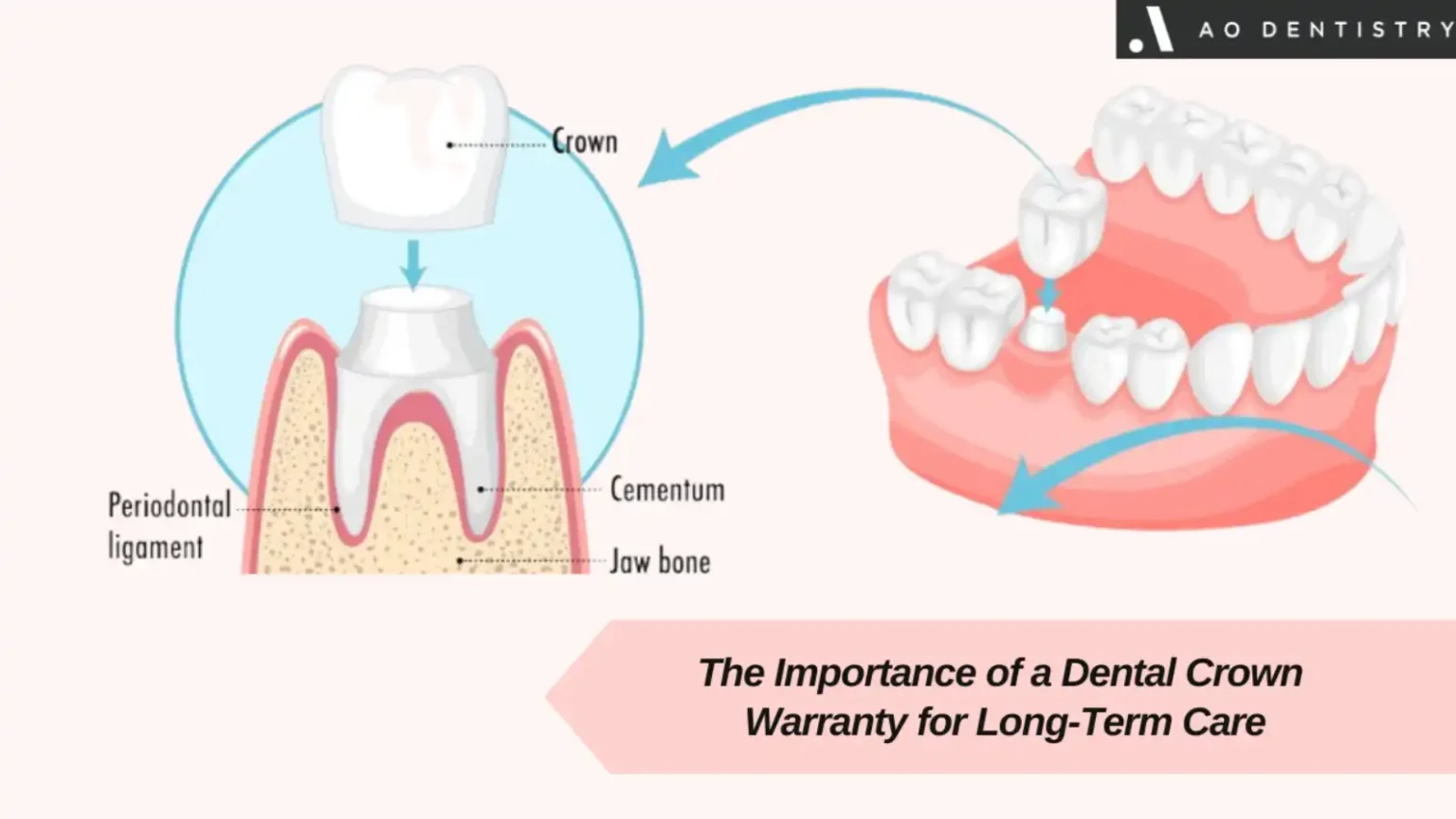 Dental Crowns Warranty