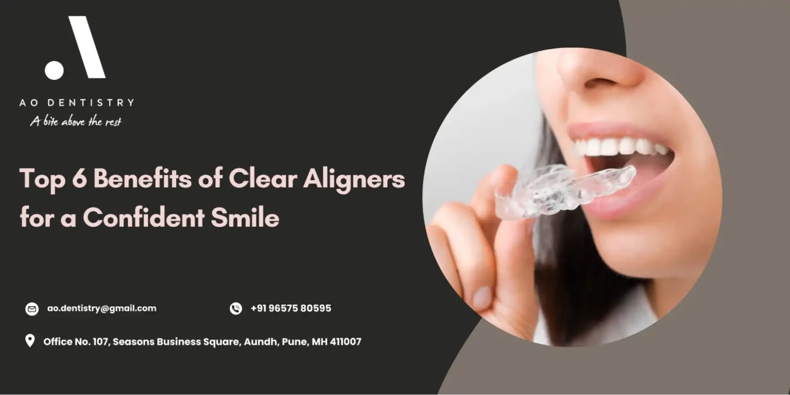 Benefits Of Clear Aligners