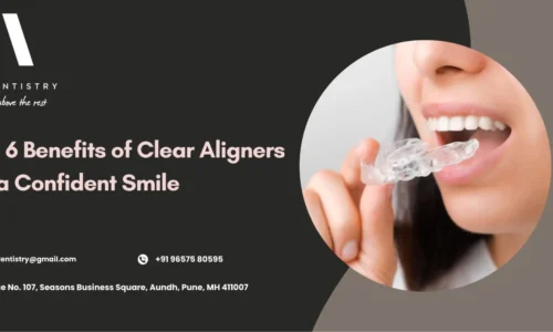 Benefits Of Clear Aligners