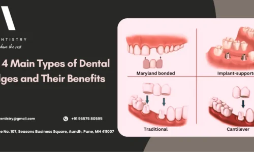 Types Of Dental Bridges