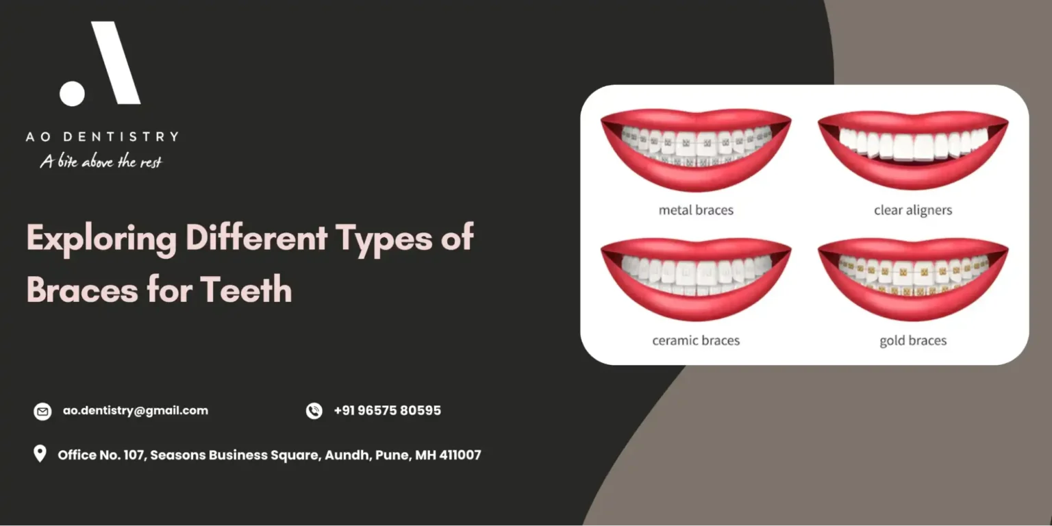 Types of Braces