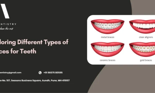 Types of Braces